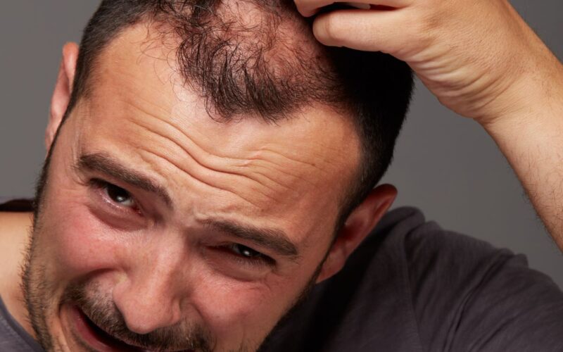 Alopecia: Entenda a Queda de Cabelo Masculina, Seus Tipos e os Melhores Tratamentos